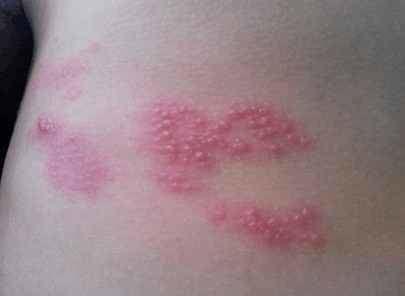 梅毒艾滋吃瓜,吃瓜群众如何看透背后的真相